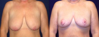 Frontal View - Breast Lift After Pregnancy & Weight Loss