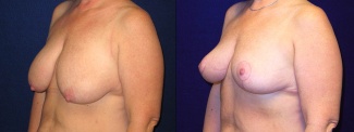 Left 3/4 View - Breast Lift After Pregnancy & Weight Loss
