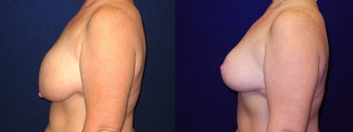 Left Profile View - Breast Lift After Pregnancy & Weight Loss