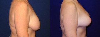 Right Profile View - Breast Lift After Pregnancy & Weight Loss