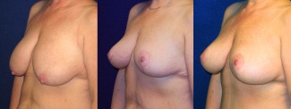 Left 3/4 View - Breast Augmentation with Lift - Silicone Implants
