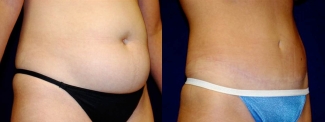 Right 3/4 View - Tummy Tuck and Hip Liposuction