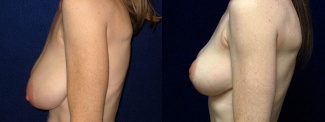 Left Profile View - Breast Reduction and Lift