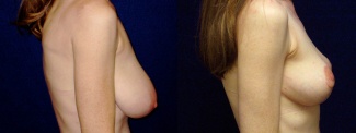 Left 3/4 View - Breast Reduction and Lift