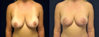 Frontal View - Breast Lift 
