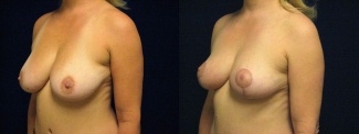 Left 3/4 View - Breast Lift 