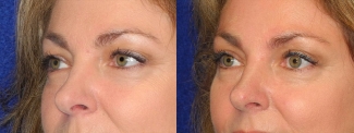 Left 3/4 View - Upper Eyelid Surgery
