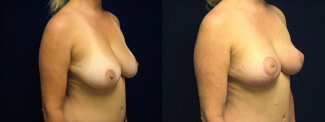 Left 3/4 View - Breast Lift 