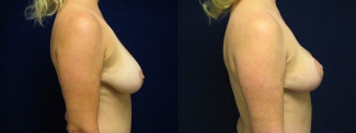 Right Profile View - Breast Lift 