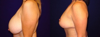 Left Profile View - Breast Lift