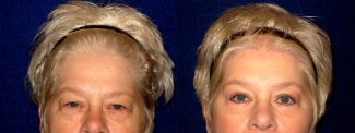Frontal View - Upper & Lower Eyelid Surgery with Browlift
