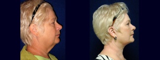 Right Profile View - Facelift with Upper and Lower Eyelid Surgery and Browlift