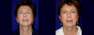 Frontal View - Facelift with Upper and Lower Eyelid Surgery and Browlift