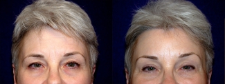 Fontal View - Upper Eyelid Surgery with Browlift