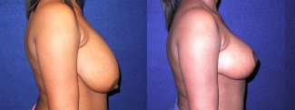 Right Profile View - Breast Reduction