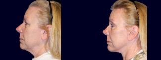 Left Profile View - Facelift, Eyelid Surgery, & Browlift