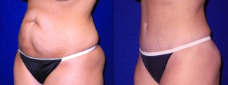 Left 3/4 View - Tummy Tuck After Pregnancy