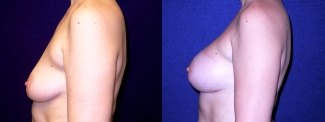 Left Profile View - Breast Augmentation - Silicone Implants