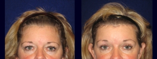Fontal View - Browlift with Upper Eyelid Surgery