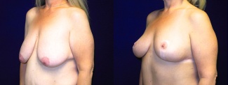 Left 3/4 View - Breast Lift After Massive Weight Loss