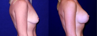 Right Profile View - Breast Augmentation with Lift