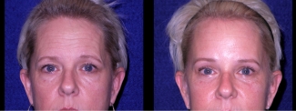 Frontal View Close Up - Facelft, Browlift and Upper Eyelid Surgery