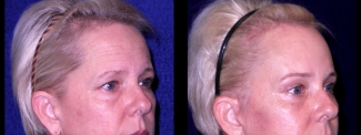 Right 3/4 View Close Up - Facelft, Browlift and Upper Eyelid Surgery