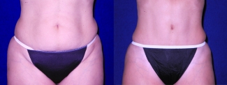 Frontal View - Tummy Tuck and Liposuction