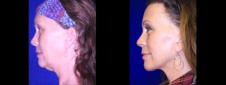 Left Profile View - Lower Facelft and Hairline Browlift