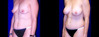 Left 3/4 View - Breast Augmentation & Tummy Tuck