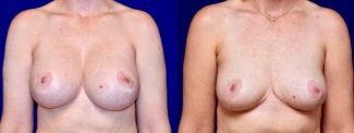 Frontal View - Breast Implant Removal