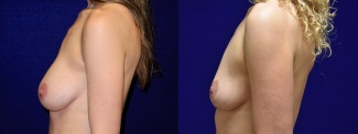 Left Profile View - Breast Implant Removal with Breast Lift