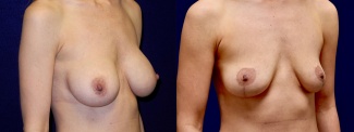 Right 3/4 View - Breast Implant Removal with Breast Lift