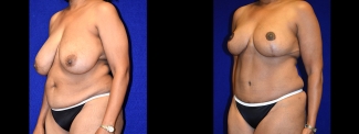 Left 3/4 View - Breast Reduction and Tummy Tuck