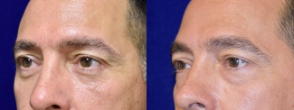 Left 3/4 View - Lower Eyelid Surgery