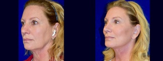 Left 3/4 View - Facelift, Browlift, Rhinoplasty