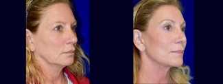 Right 3/4 View - Facelift, Browlift, Rhinoplasty