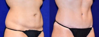 Right 3/4 View - Surgery After Weight Loss Tummy Tuck