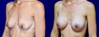 Left 3/4 View - Breast Augmentation with Nipple Reduction
