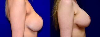 Right Profile View - Breast Augmentation Revision with Galaflex