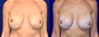 Frontal View - Breast Augmentation Revision with Galaflex