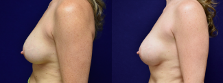 Left Profile View - Breast Implant Revision with Galaflex