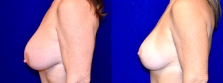 Left Profile View - Breast Implant Revision and Breast Lift