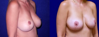 Right 3/4 View - Breast Implant Revision with Galaflex