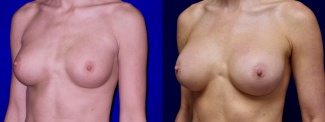 Left 3/4 View - Breast Implant Revision with Galaflex