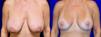 Frontal View - Breast Augmentation Revision with Galaflex
