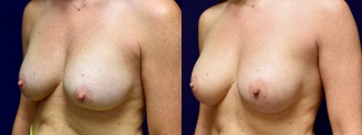 Left 3/4 View - Breast Implant Revision with Galaflex