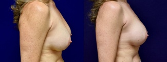 Right Profile View - Breast Implant Revision with Galaflex