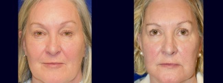 Frontal View - Eyelid Surgery
