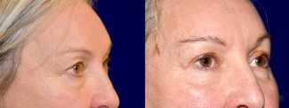 Right 3/4 View - Eyelid Surgery